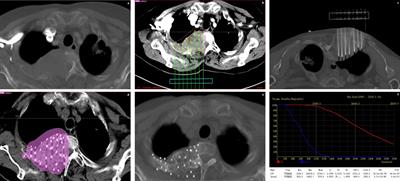 Efficacy and safety of CT-guided 125I seed implantation by coplanar template as a salvage therapy for vertebral metastases after failure of external beam radiation therapy: a retrospective study